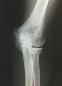 変形性肘関節症イメージ