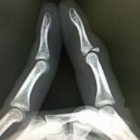 手指の骨折・靱帯損傷レントゲン写真