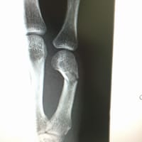 手指の骨折・靱帯損傷レントゲン写真